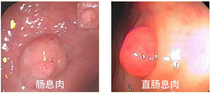 肠息肉表现
